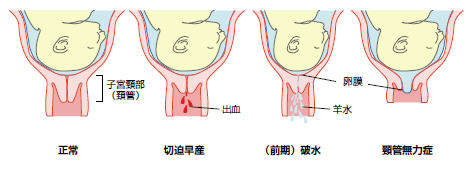 早産説明図