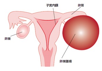 腫瘍 卵巣 卵巣腫瘍とは…約9割を占める卵巣嚢腫の症状・検査法 [婦人病・女性の病気]