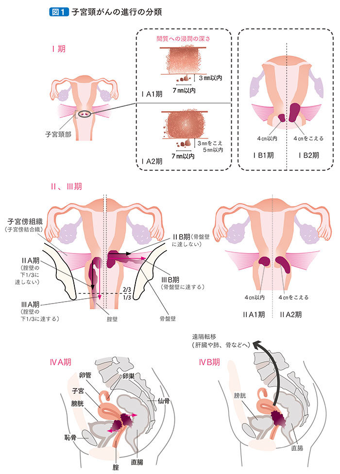 子宮 癌 症状