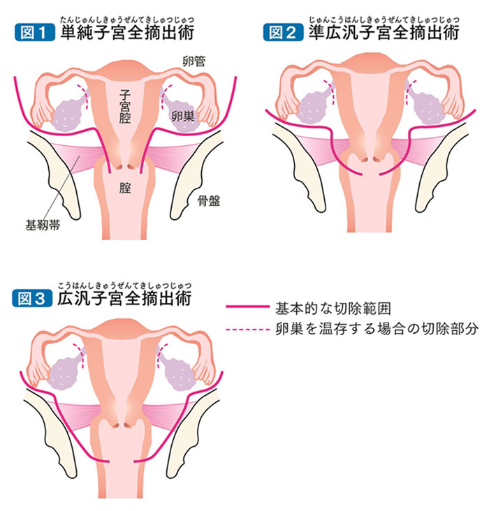 切除 術 円錐 子宮頸がん・子宮頸部円錐切除術術後の経過(退院～退院後1ヶ月)！