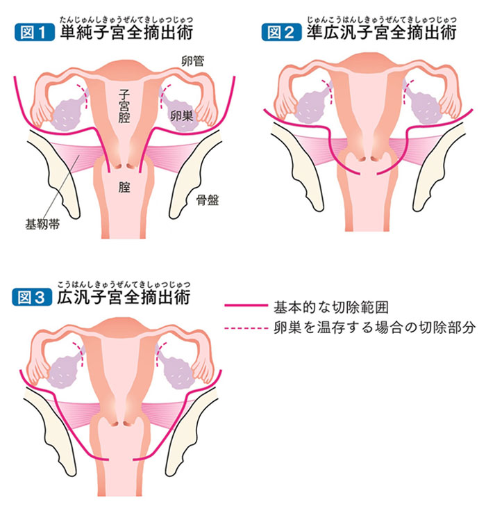 子宮 癌 症状