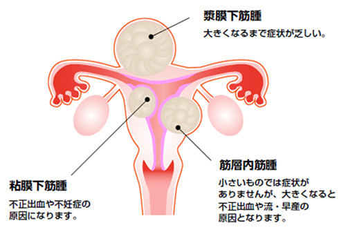 子宮筋腫｜公益社団法人 日本産科婦人科学会