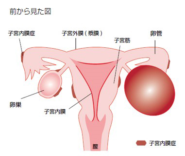 卵巣 嚢腫 再発