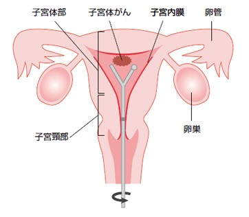 閉経 後 の 出血 異常 なし