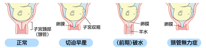 切迫 早産 入院 いつまで