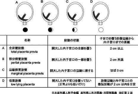 位置 胎盤 が 低い の