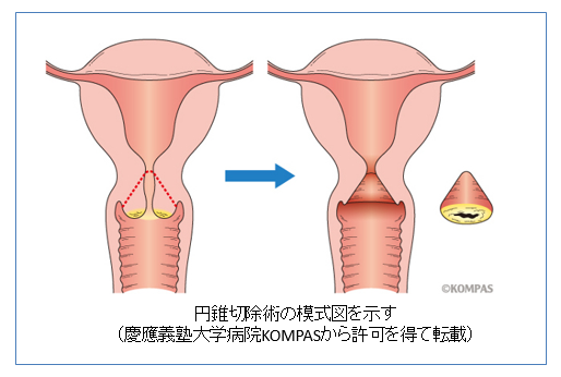 子宮頸がん説明図