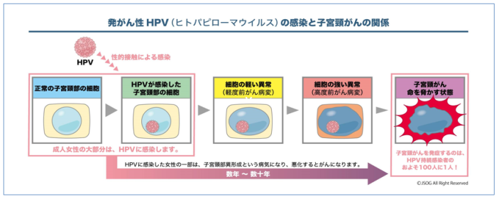 子宮頸がん説明図